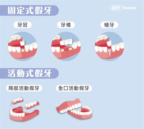 缺牙會漏財嗎|缺牙一定要補嗎？醫:當心造成7大後遺症，固定牙橋、活動假牙、。